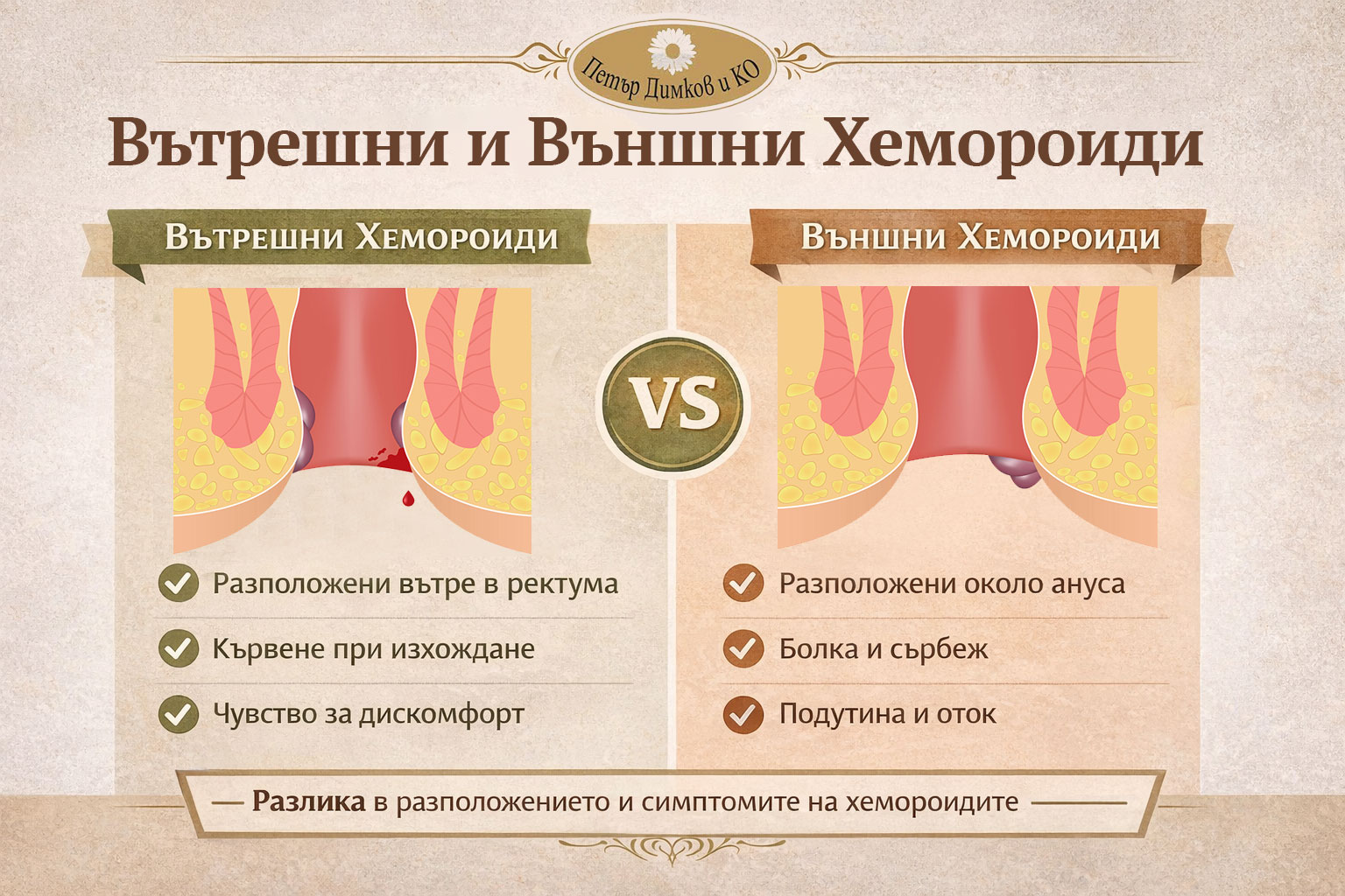 Вътрешни и външни хемороиди – разлика, разположение и симптоми